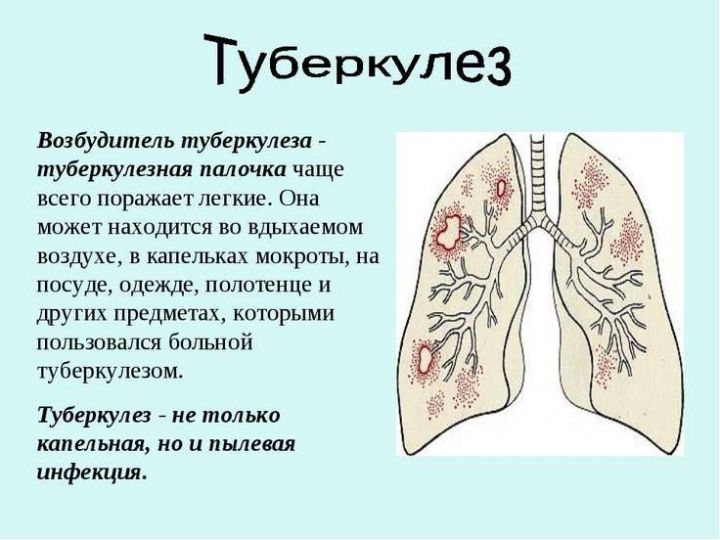 8 вещей, которые надо знать о туберкулёзе