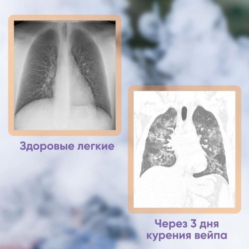 Прочти и расскажи подростку: вейпы вызывают опасное заболевание EVALI